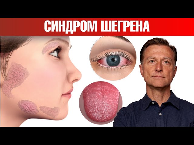 Самый эффективный протокол при синдроме Шегрена