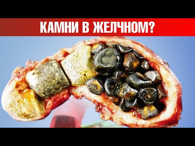 Первый симптом камней в желчном, который есть в 80% случаев