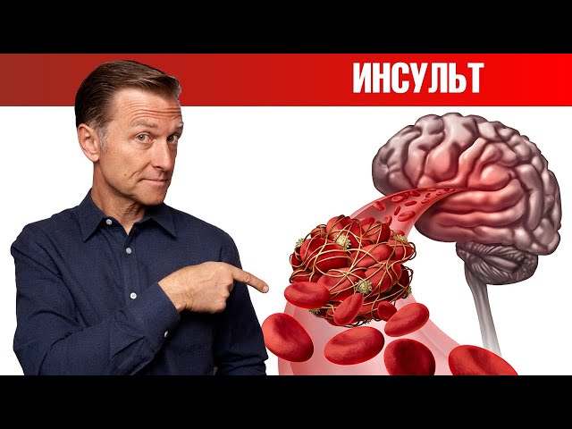 Как предсказать тихий инсульт